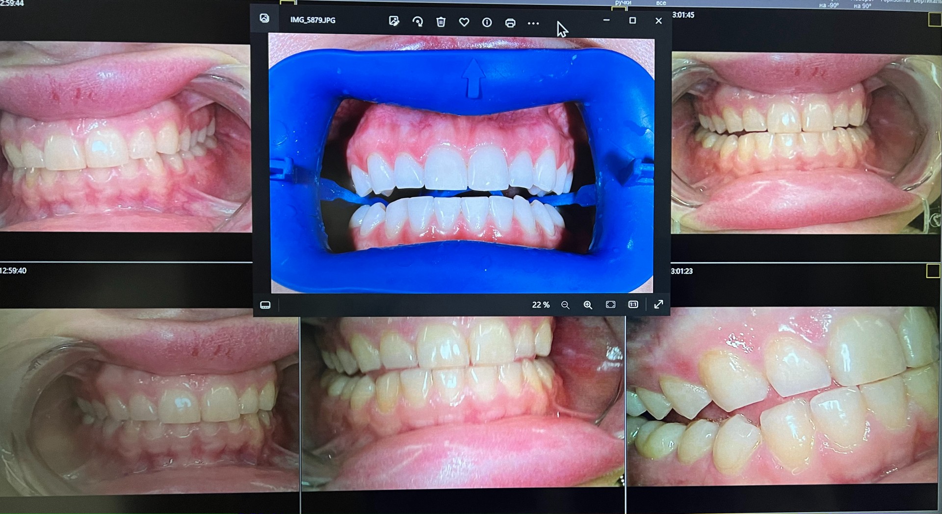 отбеливание зубов zoom4 и лазером фото улыбок